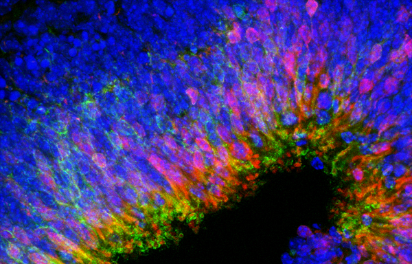 07/24/13 Retinal Stem Cell Transplant